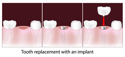 Tooth replacement with a dental implant
